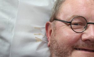 Un homme ayant des aiguilles d'acupuncture plantées dans l'oreille