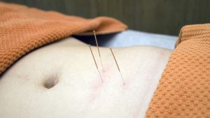 L'acupuncture peut agir sur l'hypofertilité